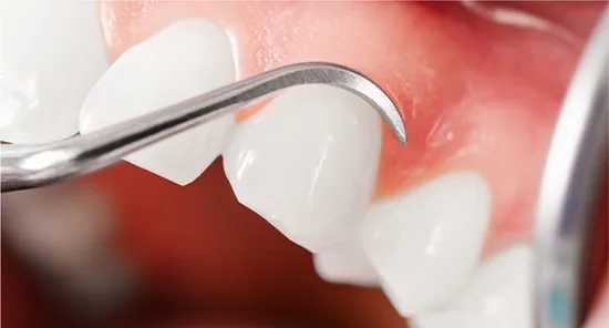 Scaling and root planing treatment